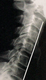 Loss of Normal Neck Curve